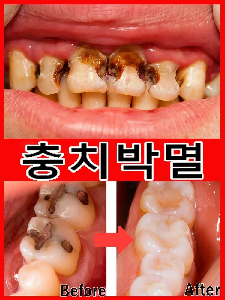 Dental Caries Repair Serum Prevent Tooth Decay Protect Teeth Remove Plaque Oral Cleaning Natural Herbal Extract 30ml