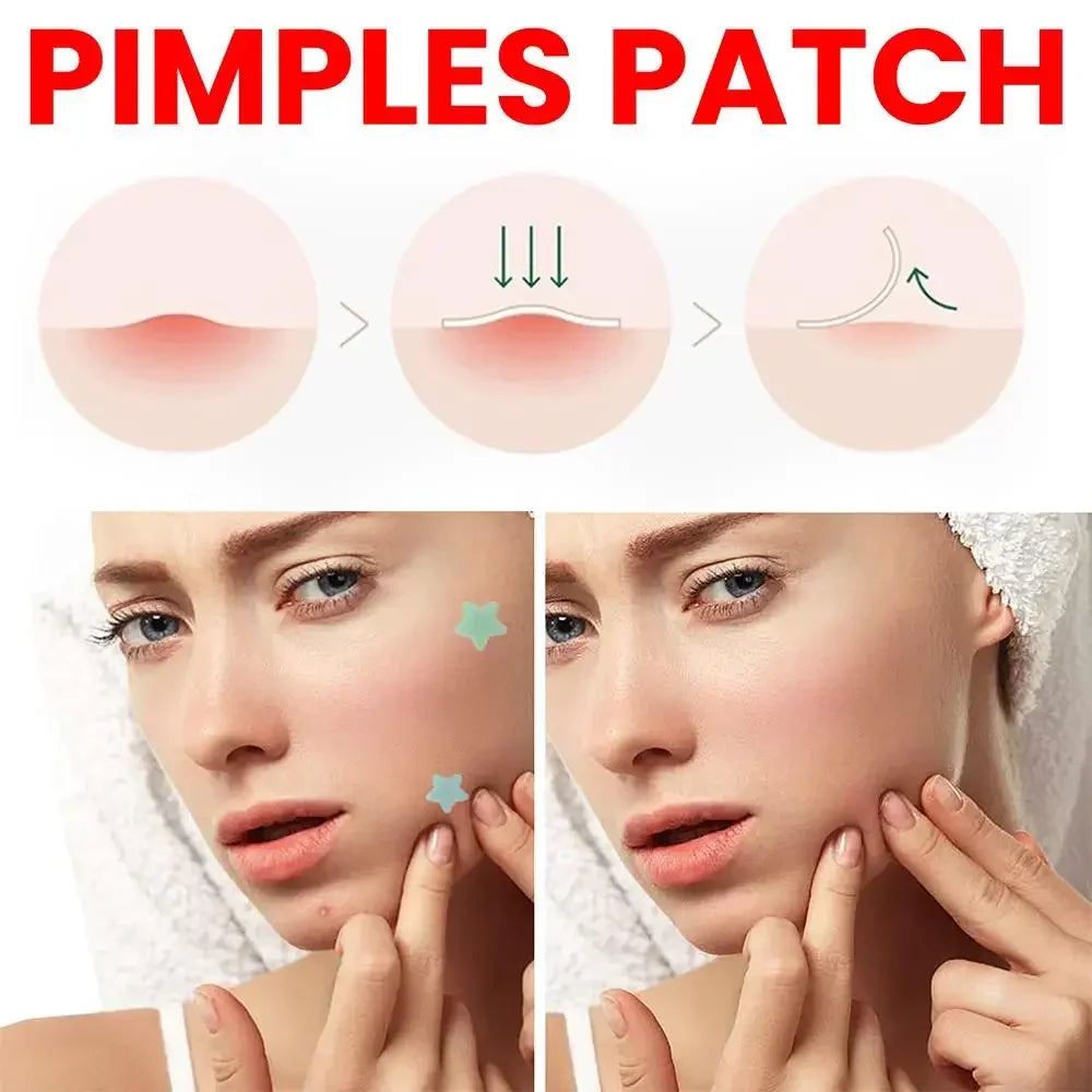 200pcs Star Pimple Patch Acne Colorful Invisible Acne Removal Skin Care Stickers  Face Spot Beauty Makeup Tool