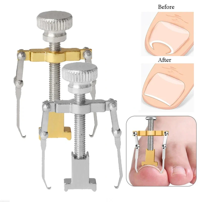 Straightening Clip Ingrown Toenail Corrector Pedicure Foot Nail Care Tools Stainless Steel Pedicure Treatment Onyxis Correction