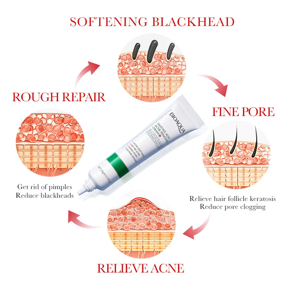 Salicylic Acid Acne Removal Cream