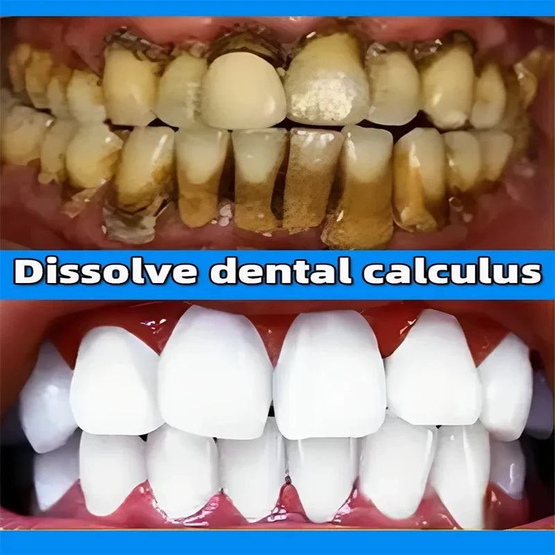 Dental Calculus Remove Whitening Teeth Toothpaste Brightening Removal Bad Breath Dental Preventing Periodontitis Cleansing Care