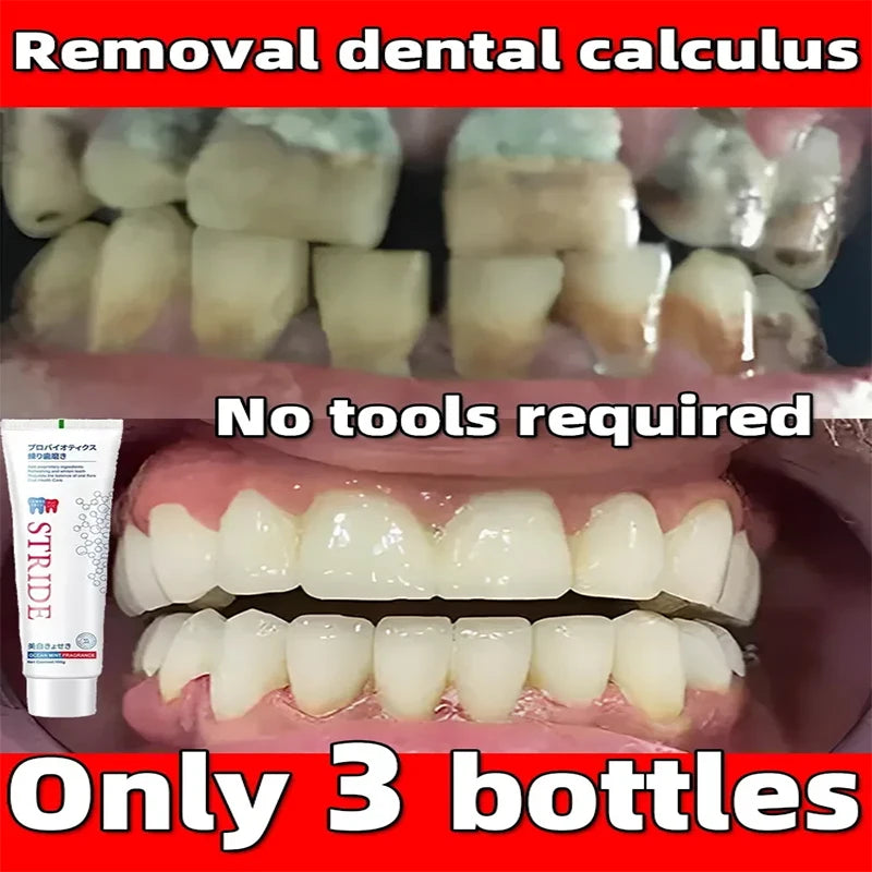 Dental Calculus Remove Whitening Teeth Toothpaste Brightening Removal Bad Breath Dental Preventing Periodontitis Cleansing Care